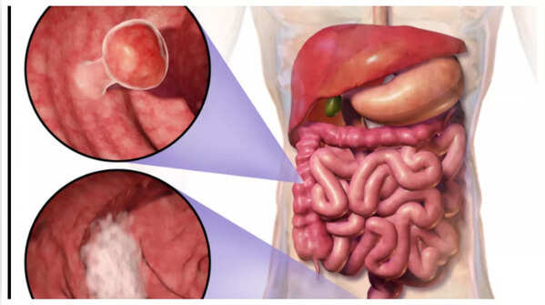 Close-up of blood in stool, a sign of possible colon cancer